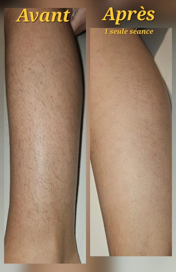 Jambe Femme Résultat avant/après