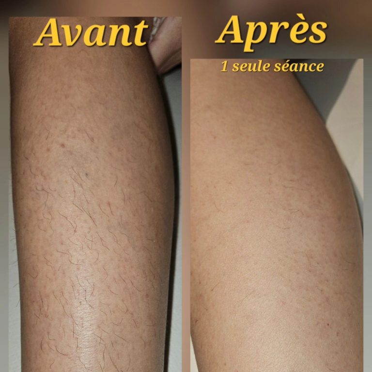 Cilféa Silféa, Silfea, Cilfea, Cilphea