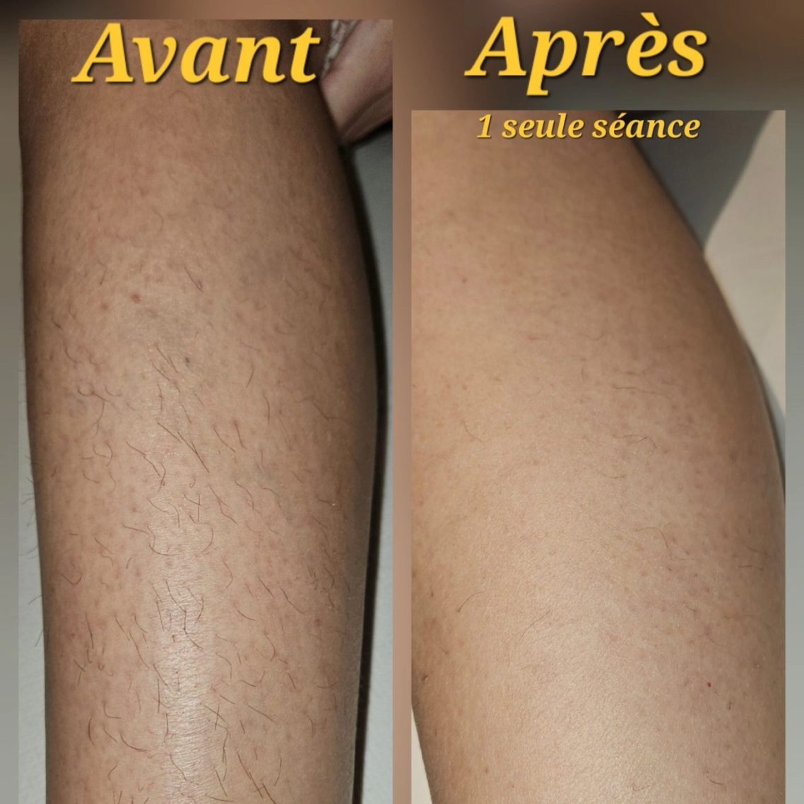 Avant/après épilation laser jambe femme Comparaison de jambes avant et après traitement épilation laser, montrant une peau plus lisse.