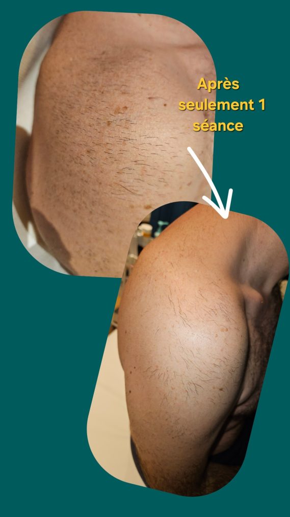 Epaule Homme résultats avant/après